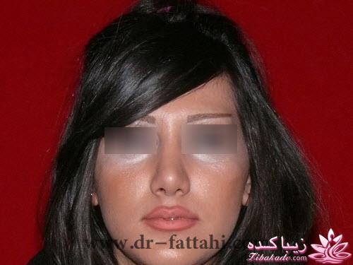 جراحی بینی - جراحی زیبایی